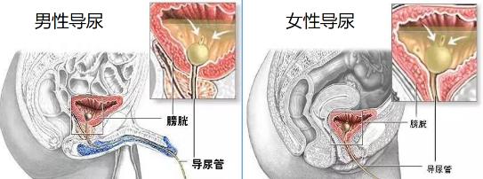 恥骨前彎消失,利於插管;插管時動作要輕柔,到達尿道狹窄部時,切忌用