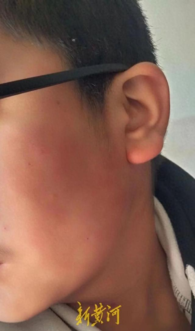 张家口13岁男孩被教师扇耳光致视力严重受损?
