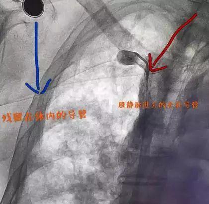 3,四個小時後送病人去dsa室,局麻後經右側股靜脈入路,豬尾套扎導管在