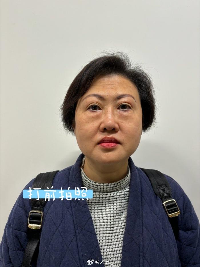 我妈在我这里团的直白抗衰套餐，打完超声炮半个月了……