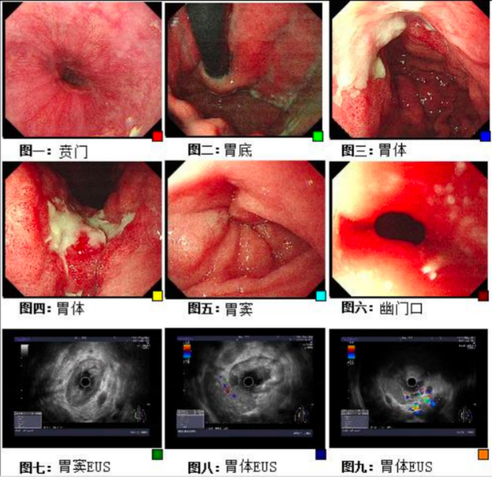 图2.纤维胃镜检查（2023年2月6日）