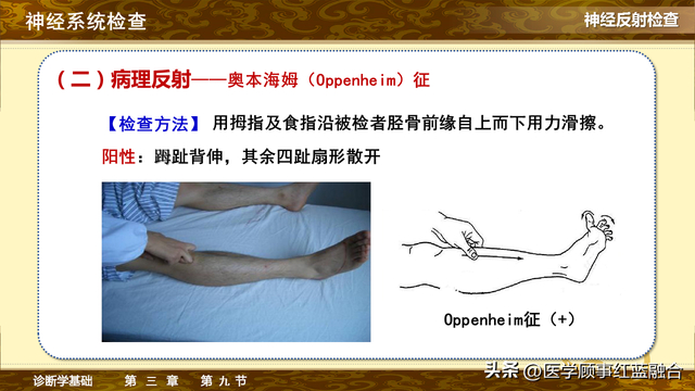 oppenheim奥本海姆征|锥体束|奥本海姆|阳性_新浪新闻