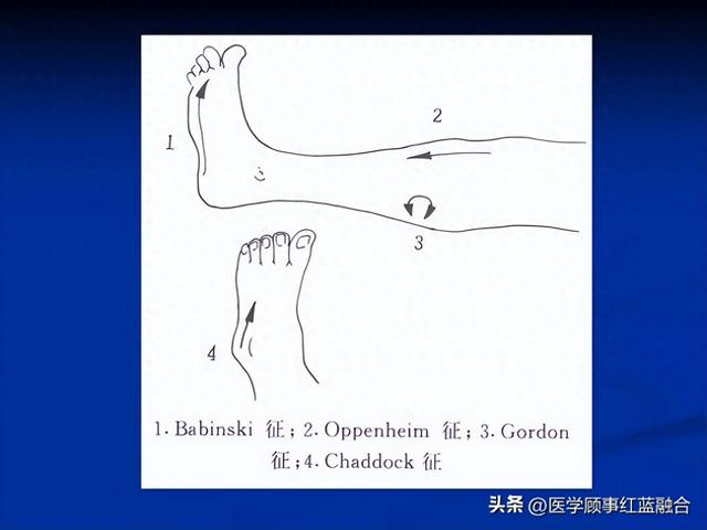 束有损害患者的检查,阴性代表正常,而阳性代表存在锥体束损害的情况