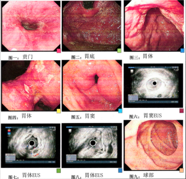 图6.纤维胃镜检查（2023年6月24日）