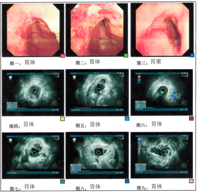 图4.纤维胃镜检查（2023年4月15日）