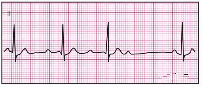 14种临床最常见心电图全收录