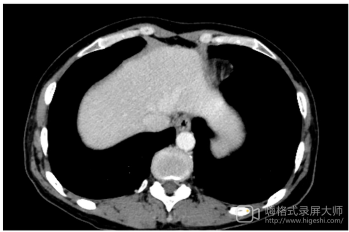 图1.腹部CT检查（2023年2月5日）