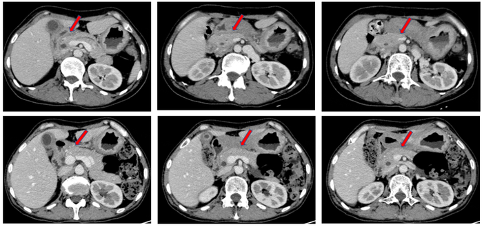 图3.腹部CT检查（上：2023年2月；下：2023年4月）