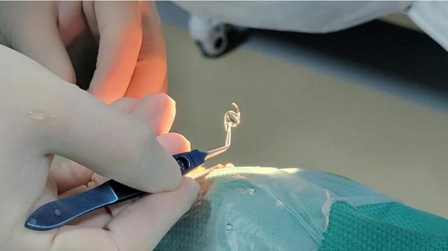 衡阳爱尔成功开展艾无级人工晶体植入白内障手术|手术|白内障|爱尔