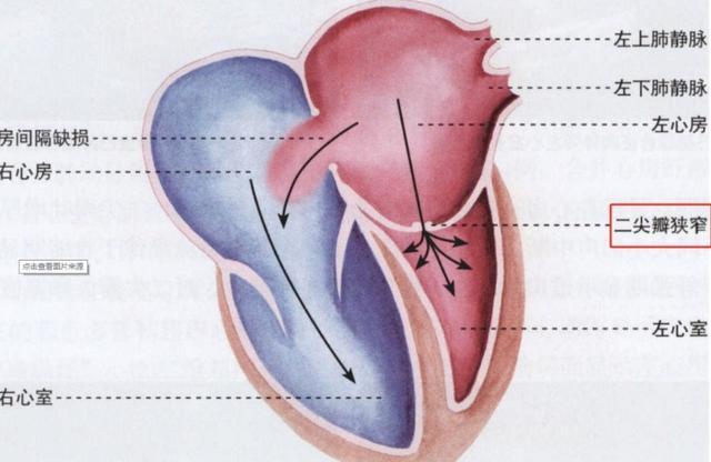 二尖瓣脸红图片
