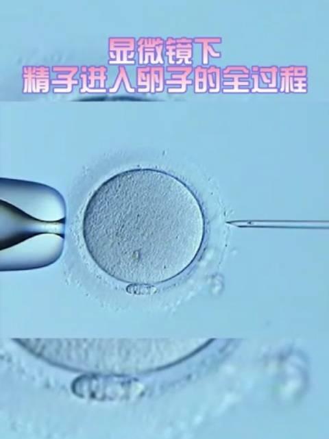 女生取卵子过程_女性取卵有多疼?实拍取卵全过程,看到冷汗直流!