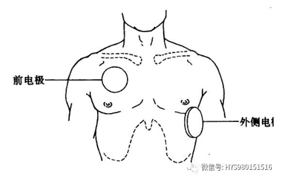 這種除顫器是將電極放在胸外,間接接觸心肌除顫.