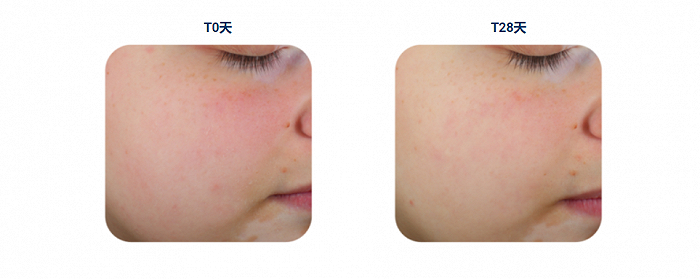 Calisensix 可缓解皮肤泛红和刺激现象