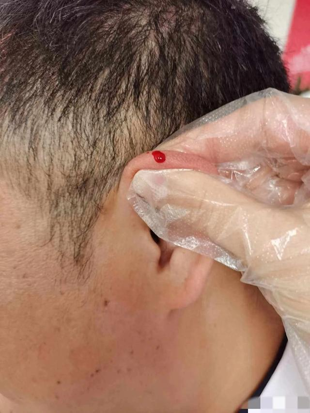 中医"神奇的耳尖放血"|中医_新浪新闻