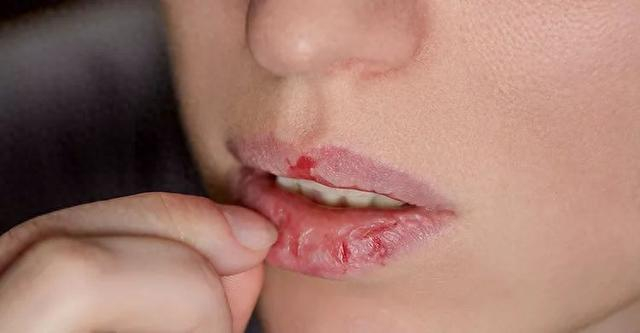 一到冬天嘴唇就干裂,起皮?