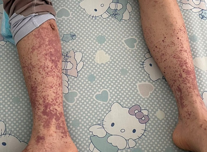 9岁紫癜患儿消化道出血性休克 南京同仁儿童医院成功救治