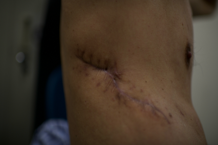 李先生向“医学界”展示他已经被修复的胸壁上曾经开的窗口/摄影 田栋梁