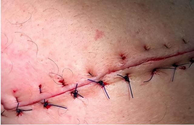 阑尾切除术--原始开腹手术切口石门县中医医院普外科田飞副主任医师