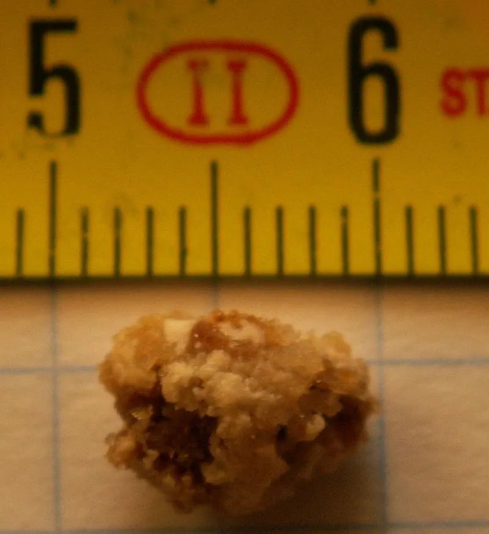 一颗8毫米大小的肾结石 图片来源：维基百科