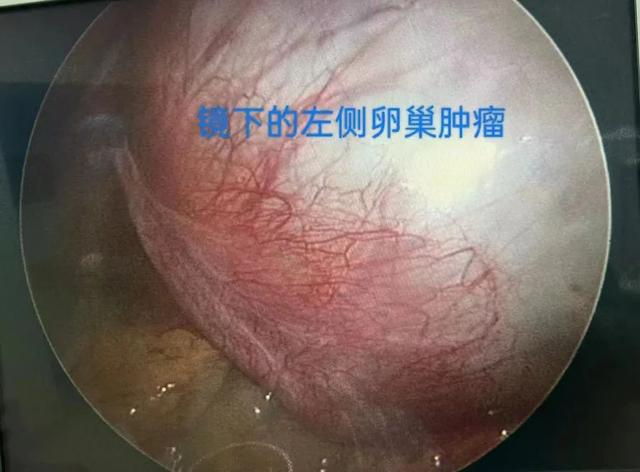 术后第一天即可下床活动,术后病理提示为卵巢良性畸胎瘤,术后第7天