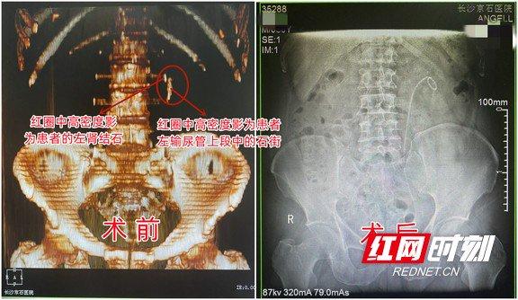 男子查出結石後霸蠻排石怎料輸尿管竟堵成了條4釐米石街