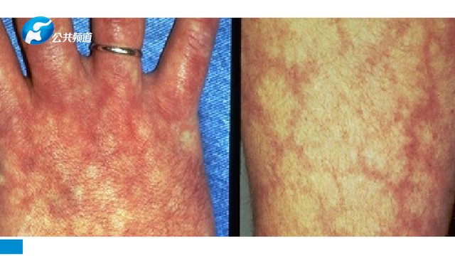 红斑狼疮|疾病|脱发_新浪新闻