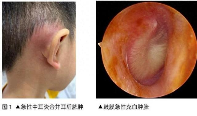 今年家长真难!孩子肺炎没好,又诱发中耳炎,多名儿童中招
