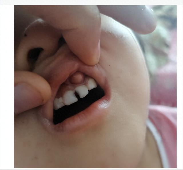 牙龈凹陷怎么回事图片