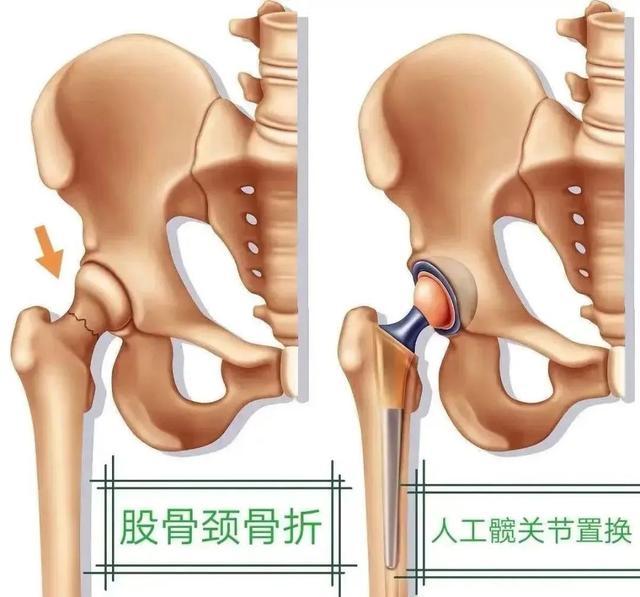 刘欢讲人工髋关节置换图片