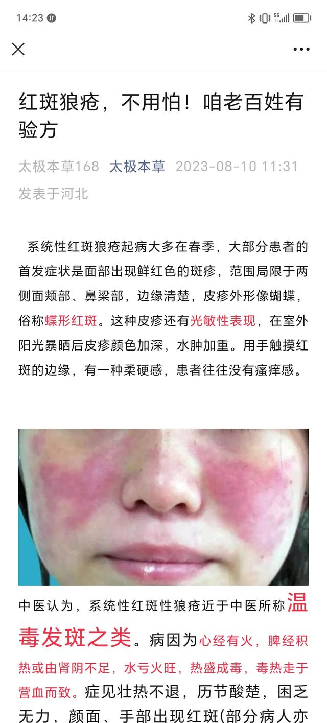 红斑狼疮,中医药能治的