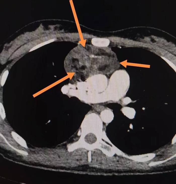 大三學生胸腔現巨大腫瘤胸外科博士團隊成功切除