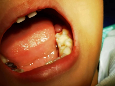 7岁男童牙龈肿痛,济南市三院用激光治疗仪为其进行口腔手术|手术|治疗