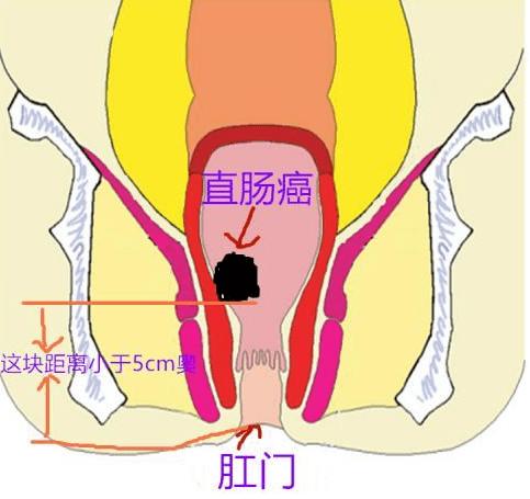 低位直腸癌除迴腸儲袋手術:內鏡下黏膜切除術(emr)等微創治療;痔,肛瘻