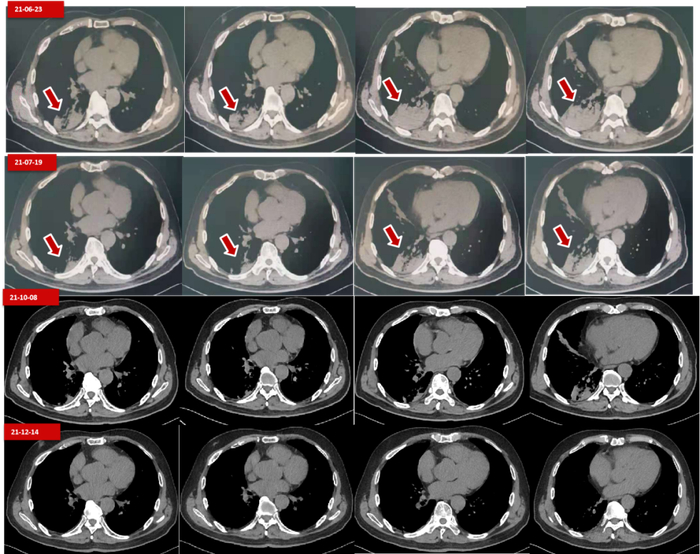 图8.  第三阶段治疗期间的胸部CT变化
