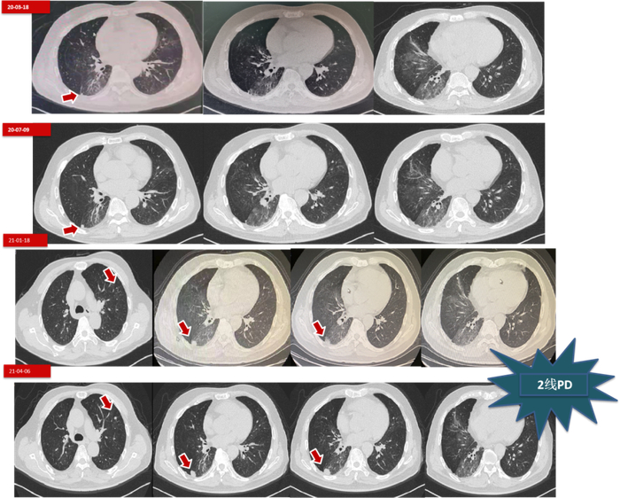 图7.  第二阶段第二次治疗的胸部CT变化