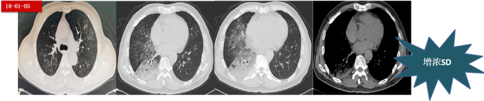 图4.  第一阶段中4个周期治疗的胸部CT变化