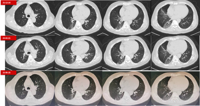图10.  第四阶段治疗期间的胸部CT变化