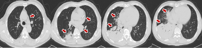 图1.  2017.03.15.胸部增强CT