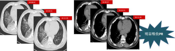 图6.  第二阶段第一次治疗的CT变化