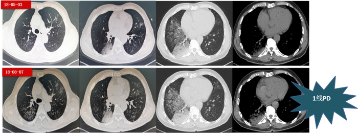 图5.  第一阶段后7个周期治疗的胸部CT变化