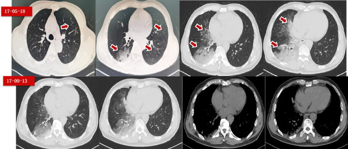 图3.  第一阶段前6个周期治疗的胸部CT变化