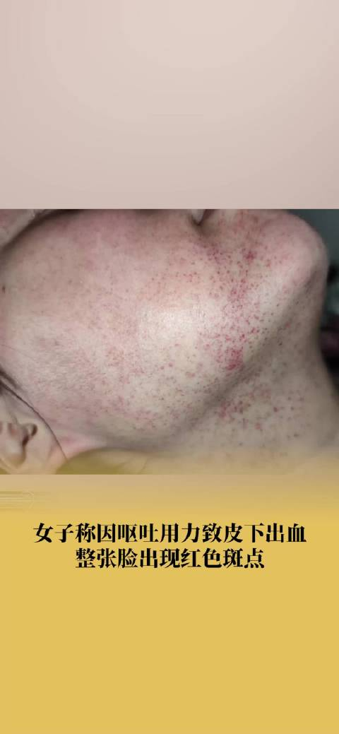 女子称因呕吐用力过度致满脸红点第二天已经变淡
