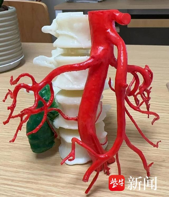 图为3D打印模型 红色部分为动脉血管 绿色部分为肿瘤组织