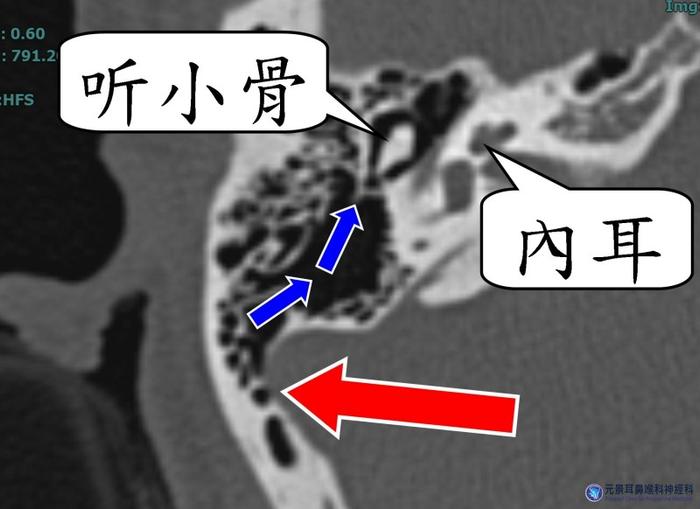 共振檢查,發現她右側大腦乙狀靜脈竇,鄰近顳骨處,缺乏骨壁,跟氣房相通