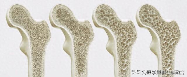 防治骨質疏鬆光補鈣還不夠關注5大核心要點