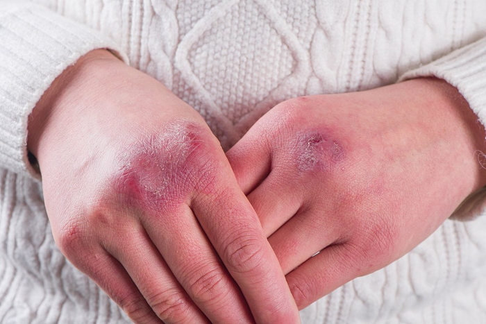 关于冻伤,你要知道这些事|第2眼|冻疮|皮肤|部位_新浪新闻