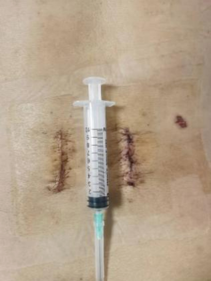 双节段的MIS-TLIF手术切口仅4.5cm/图源 重医附三院