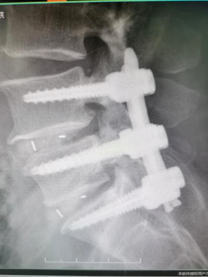 术后腰椎X-ray片提示：内固定位置满意/图源 重医附三院 