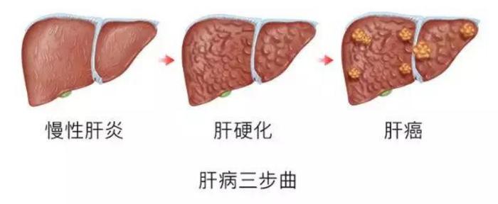 全球的肝癌人群中,中國就佔一半,而一半以上的肝癌發現時已是晚期