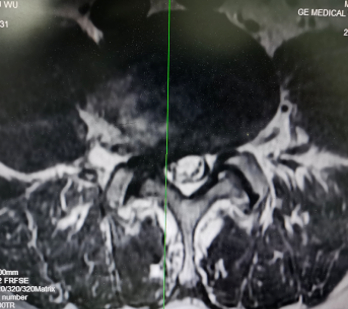 术前腰椎MRI提示：腰4/5椎间盘突出伴侧隐窝狭窄/图源 重医附三院 